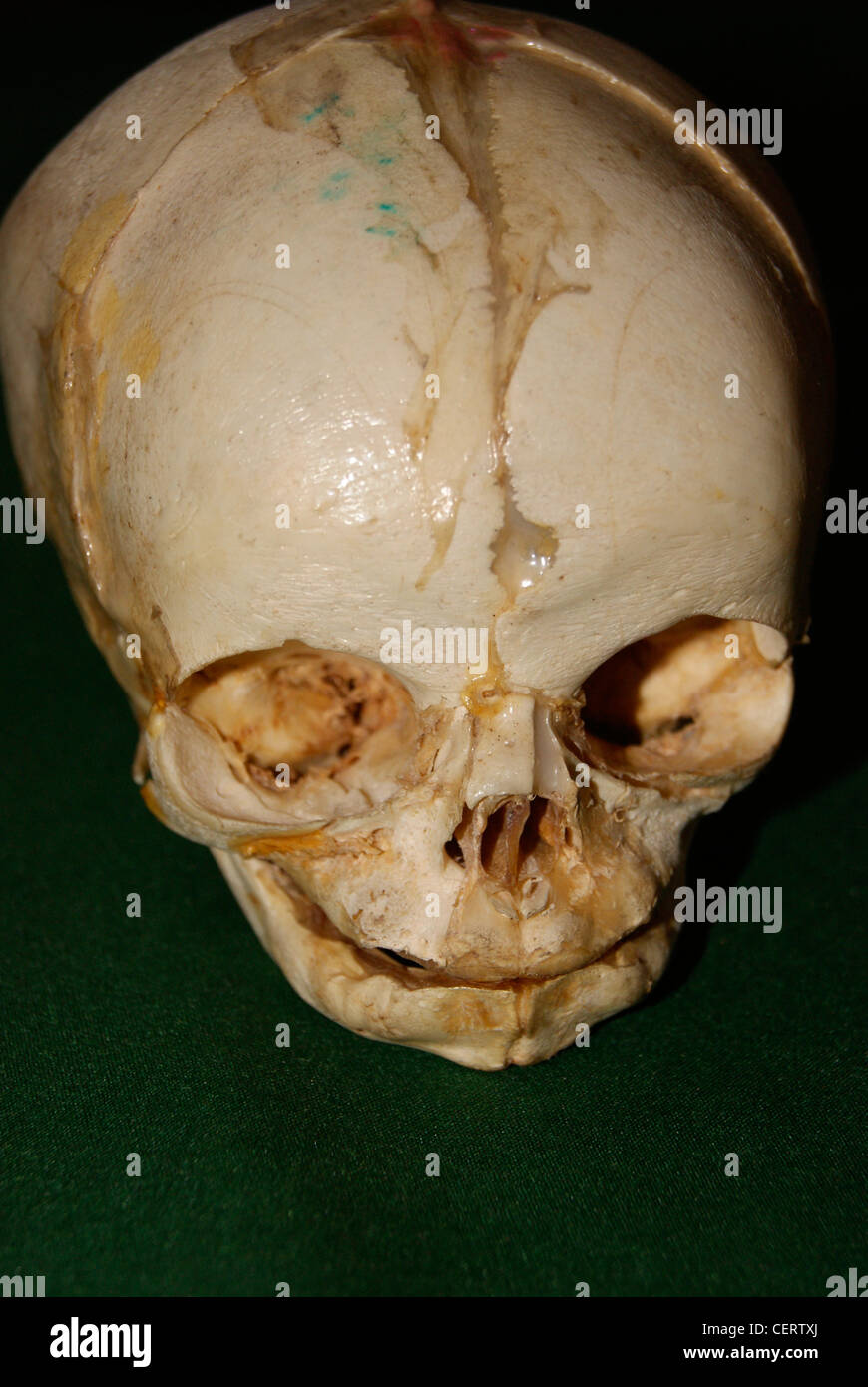 Foetal Skull. original Foetal Skull.Foetal means Fetus.Fetus Skull closeup View. Stock Photo