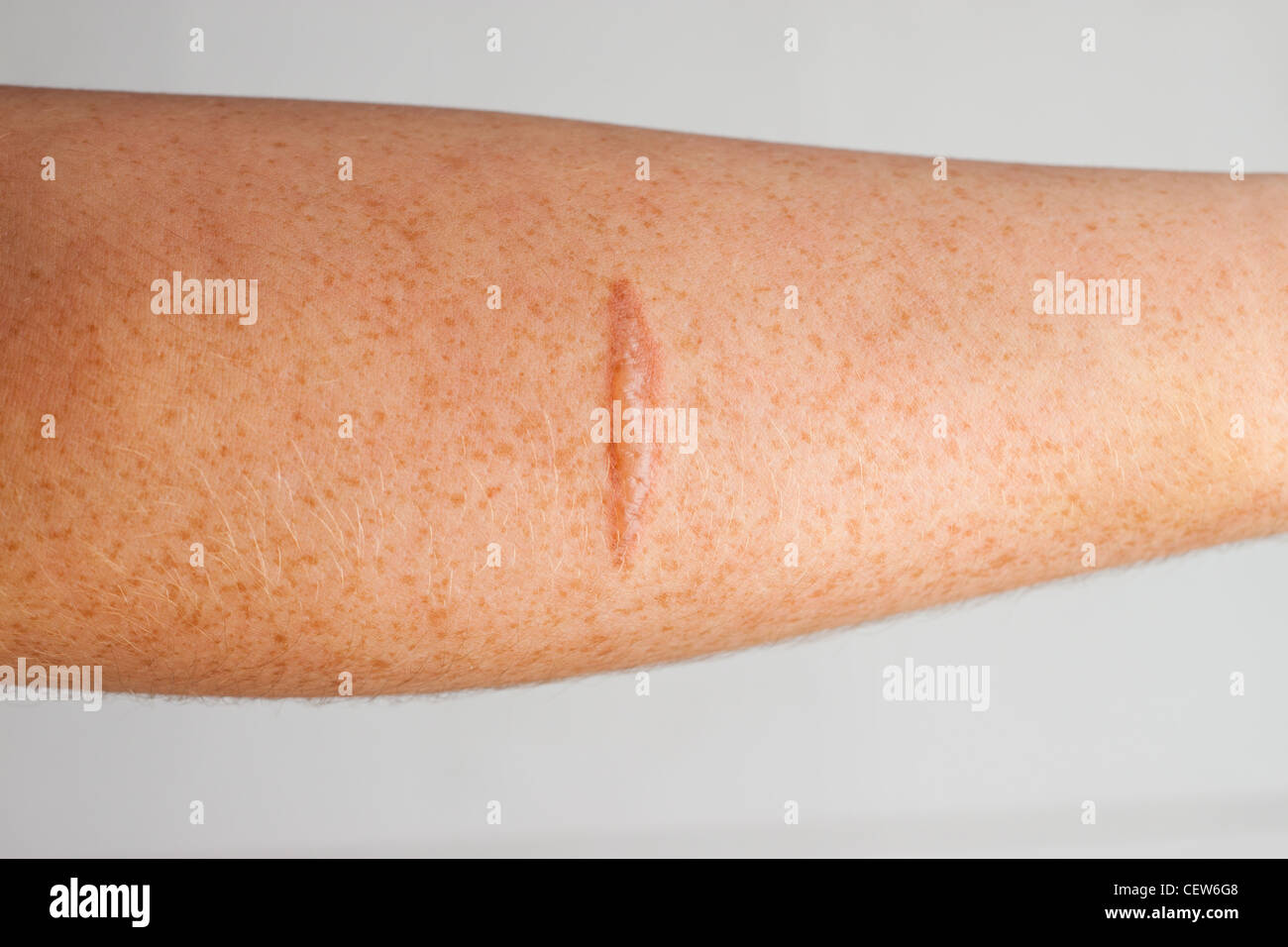 Burn scar on the skin of a persons forearm Stock Photo
