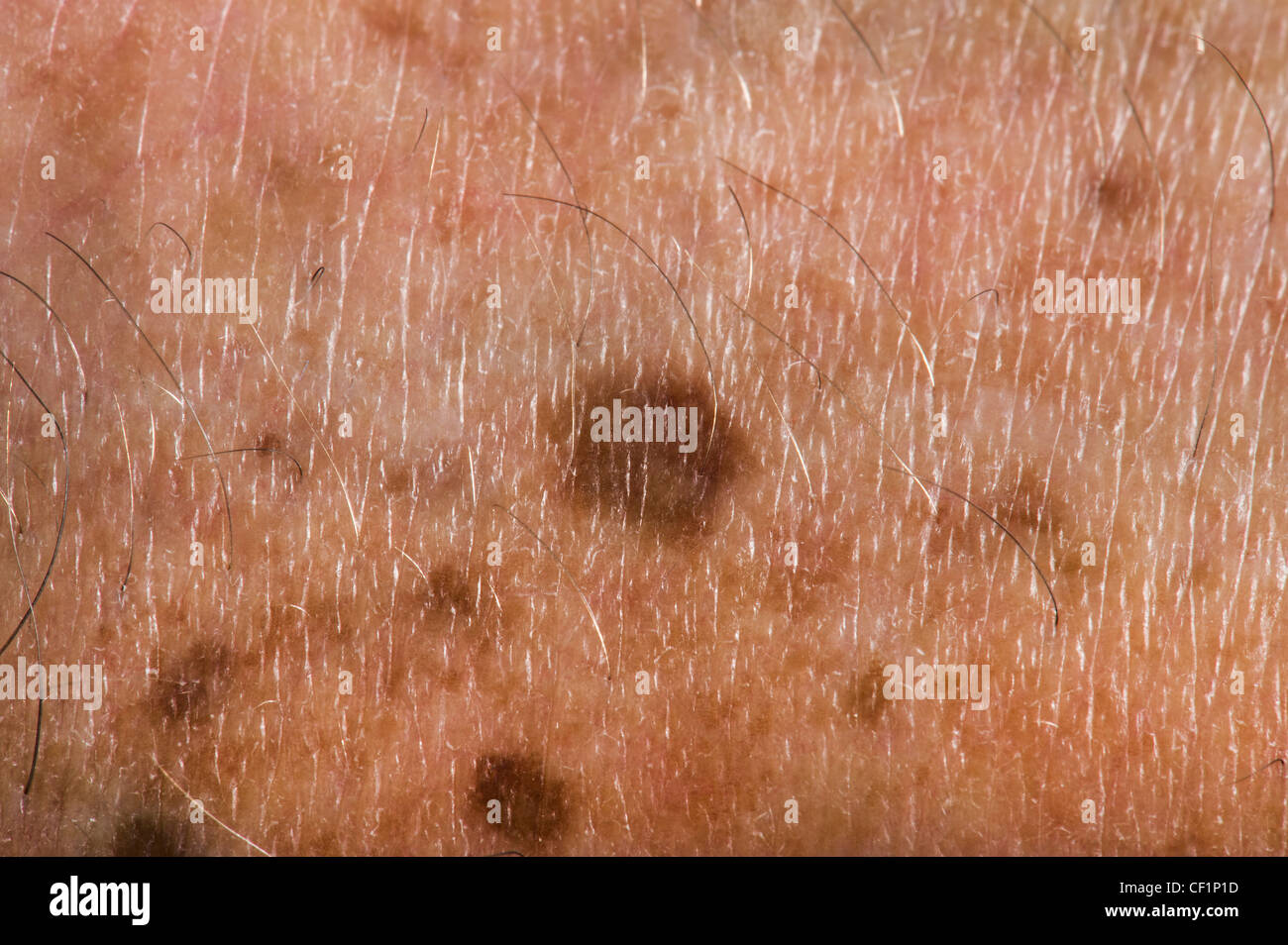 Age Spots High Resolution Stock Photography And Images Alamy