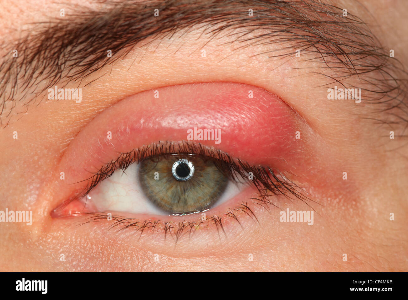 illness person eye with sty and pus looking into the camera Stock Photo