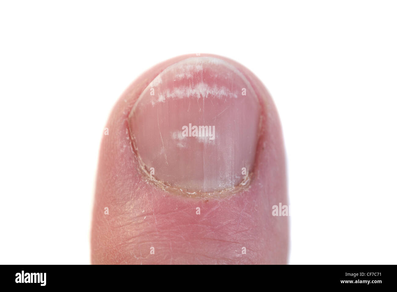 Fingernail closeup with the condition called leukonychia, white lines under the nail Stock Photo - Alamy Fingernail closeup with the condition called leukonychia, white lines under the nail Stock Photo - Alamy