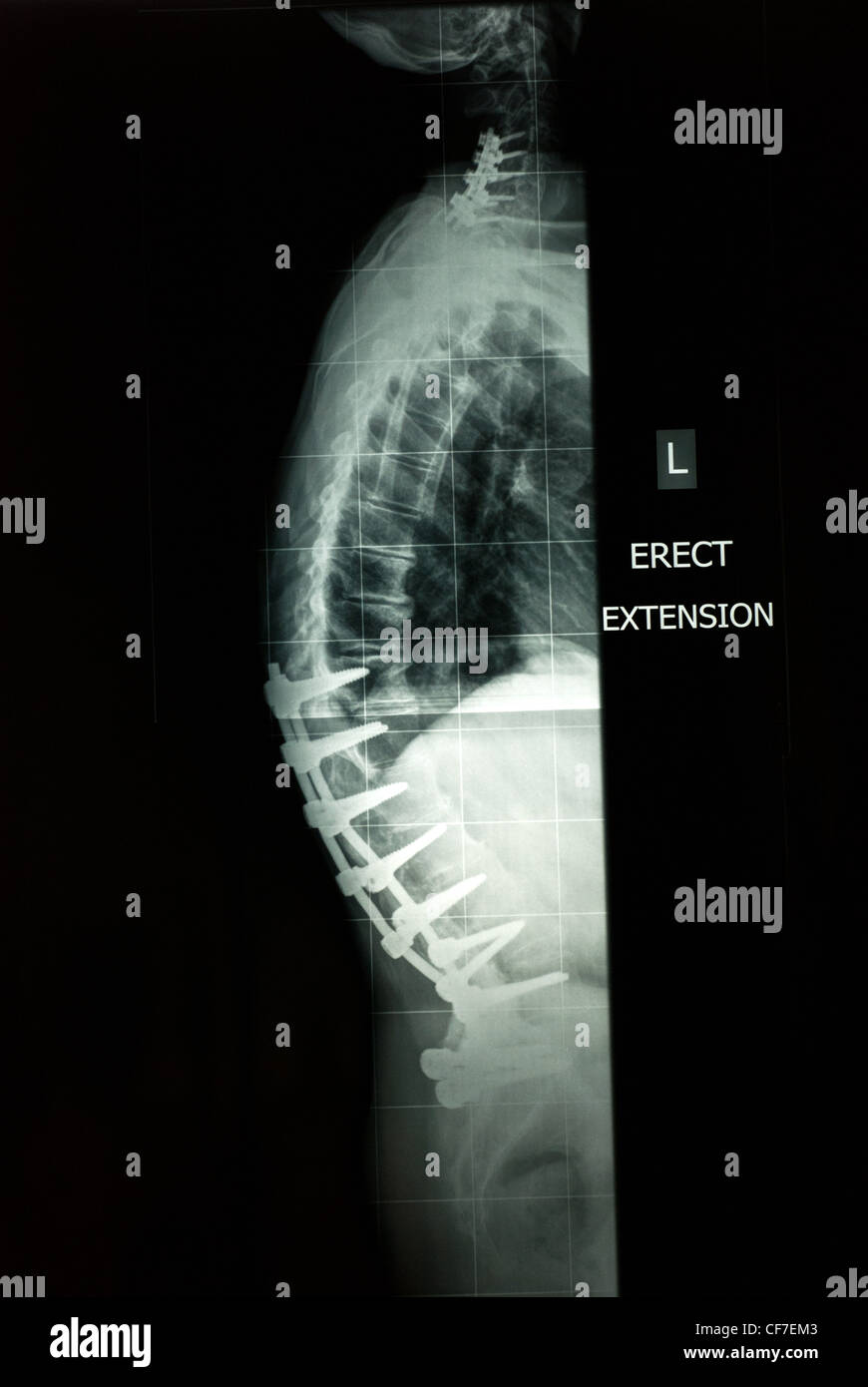 X ray of spine & neck with supporting rods & screws Stock Photo