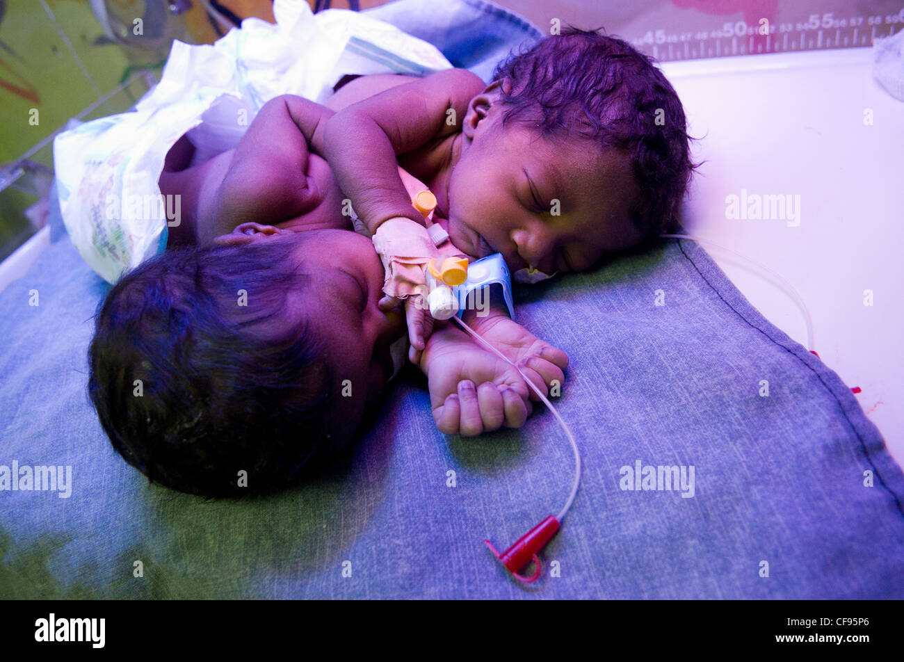 Siamese Twin Girls Siamese Twin Girls