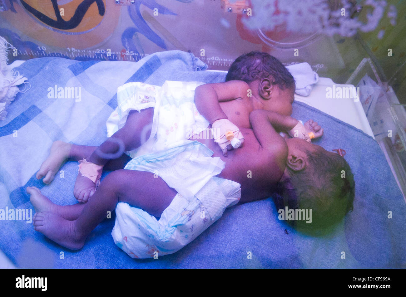 Siamese twin girls were born to 19-year-old Agnes Anyait and Augustine Ojangole, 23, Saturday 22 October 2011. Kampala, Uganda. Stock Photo