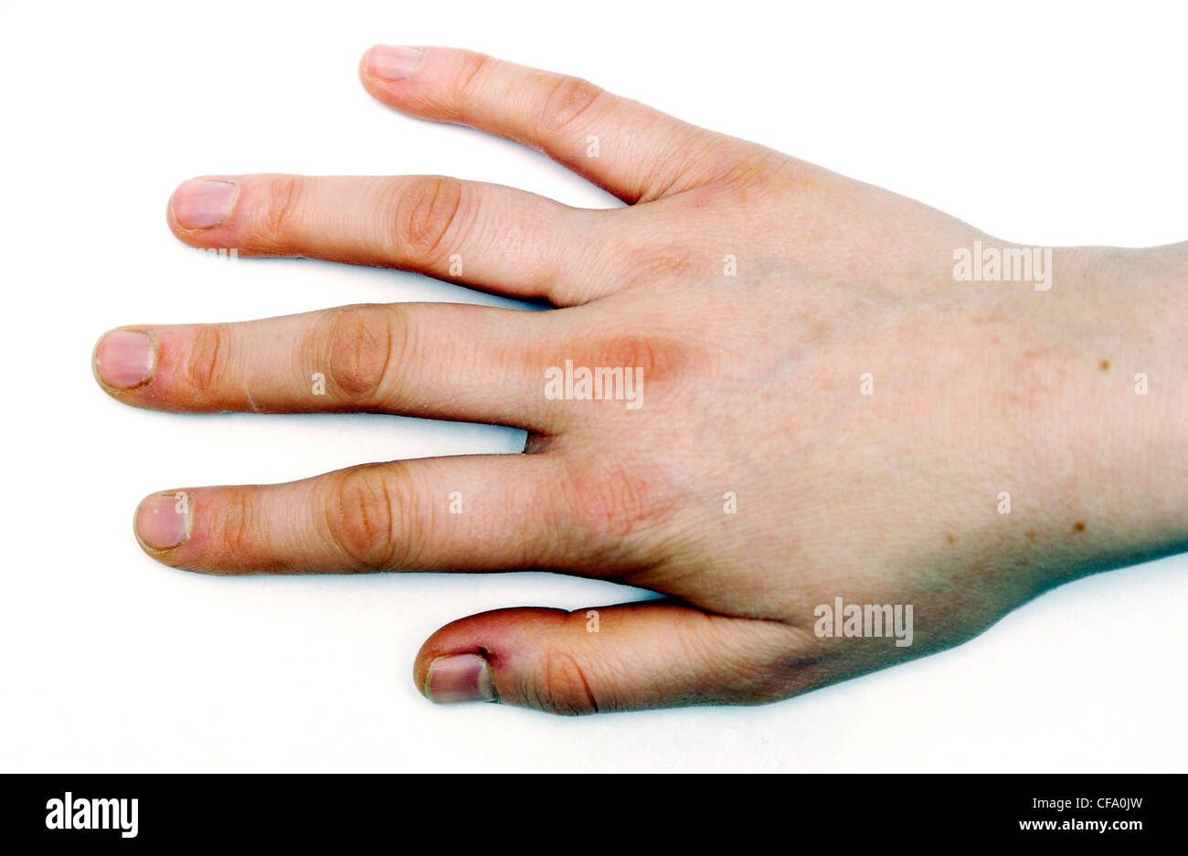 Brittle nails hires stock photography and images Alamy