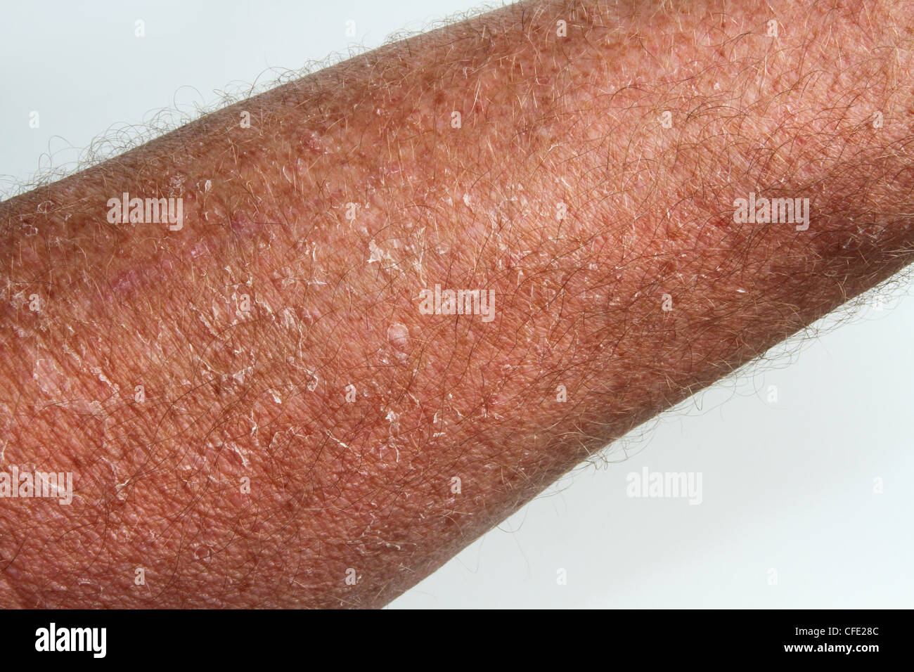 Sunburned Peeling Skin. Dead skin peeling due to overexposure in the sun about 12 days earlier. Caucasion male forearm shown. Stock Photo