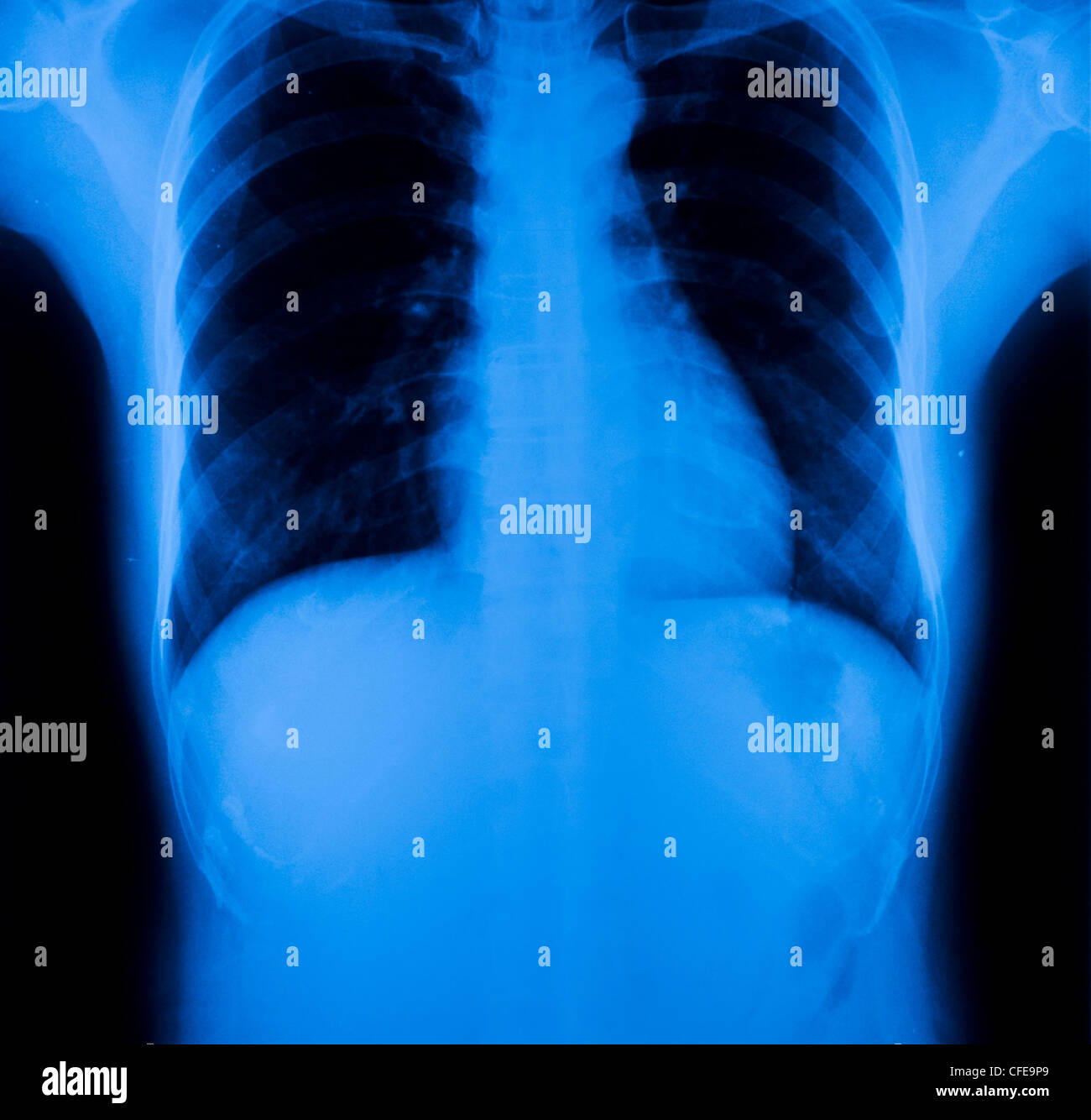 Xray of chest and lungs Stock Photo Alamy