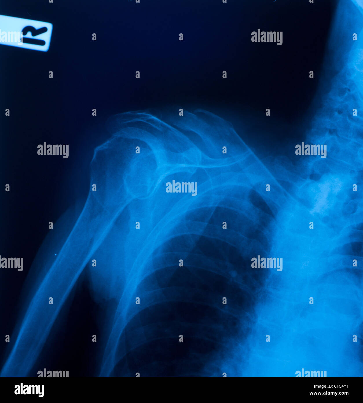 Xray film of shoulder fracture Stock Photo Alamy
