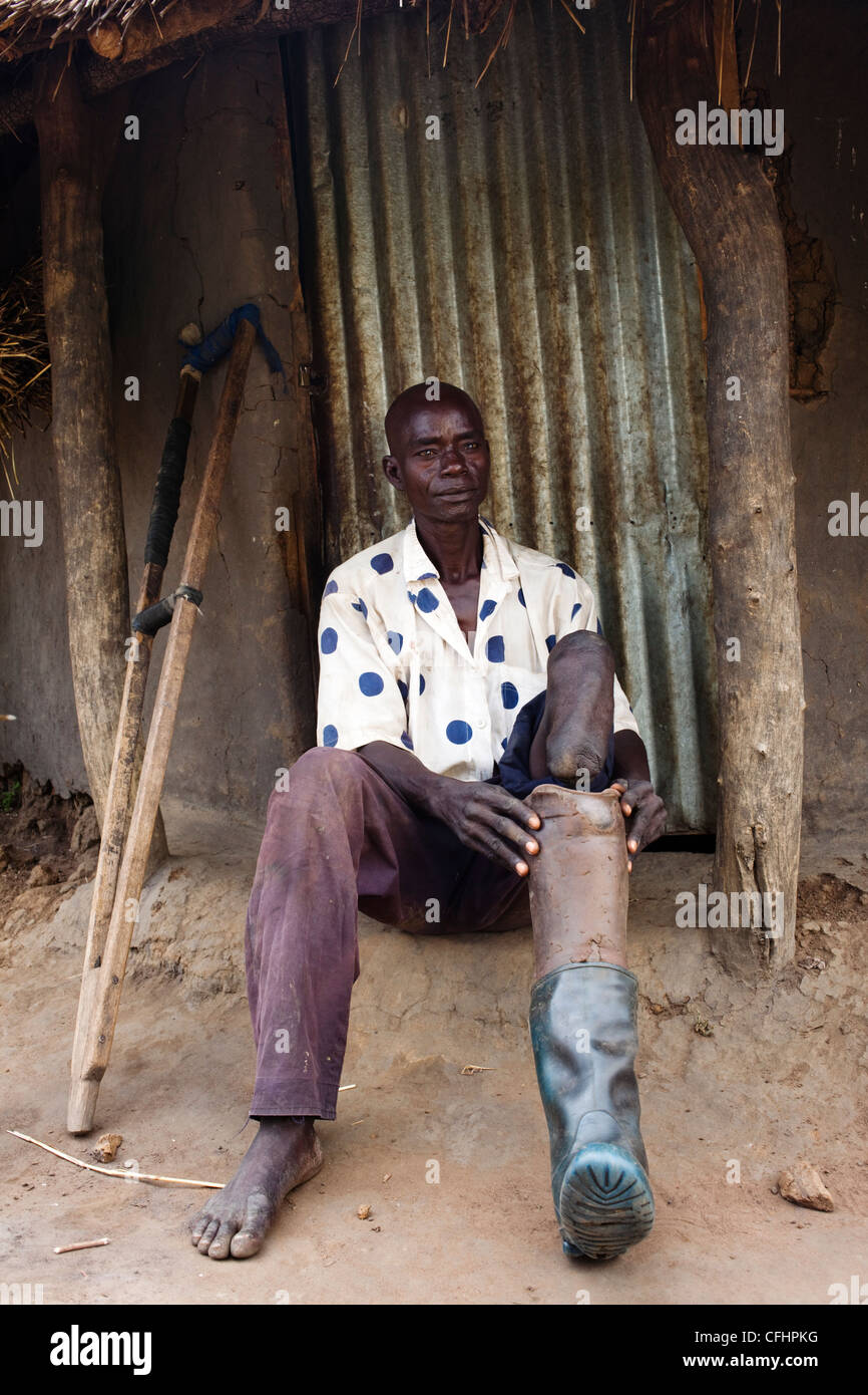 Former soldier with the LRA who lost a leg in the war in northern Uganda Stock Photo
