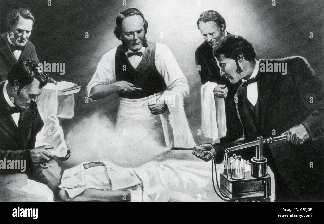 JOSEPH LISTER (1827-1912) British surgeon (centre) watches assistant using his sterilizing carbolic acid spray Stock Photo