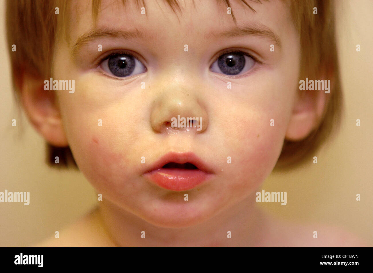 9 month old runny nose