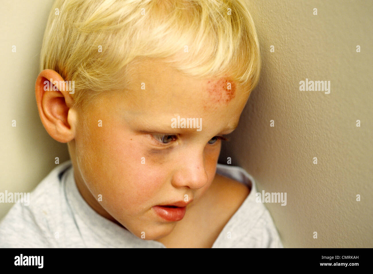 BOY WITH BRUISED FOREHEAD Stock Photo - Alamy