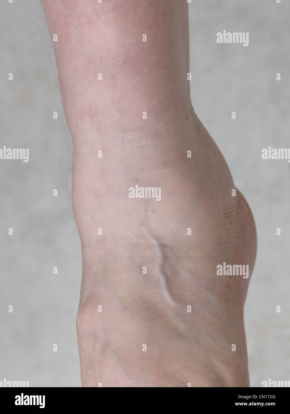 Woman s Swollen Ankle Stock Photo Alamy