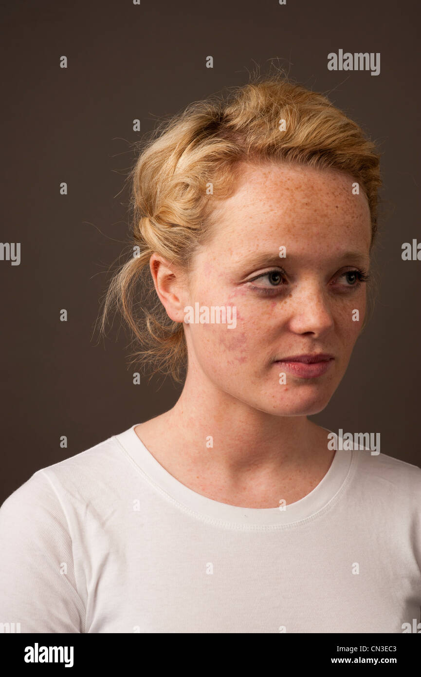Red birthmark on face hires stock photography and images Alamy