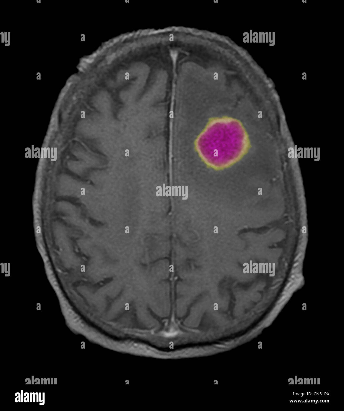 MRI scan slice through the brain of an 87 year old man, showing an encapsulated  abscess in the left frontal lobe. Stock Photo