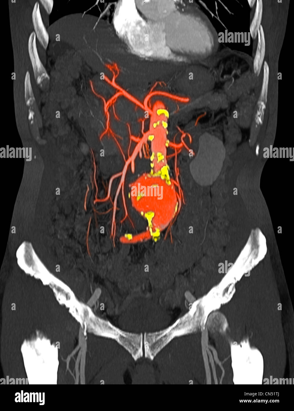 CT scan images showing an abdominal aortic aneurysm Stock Photo