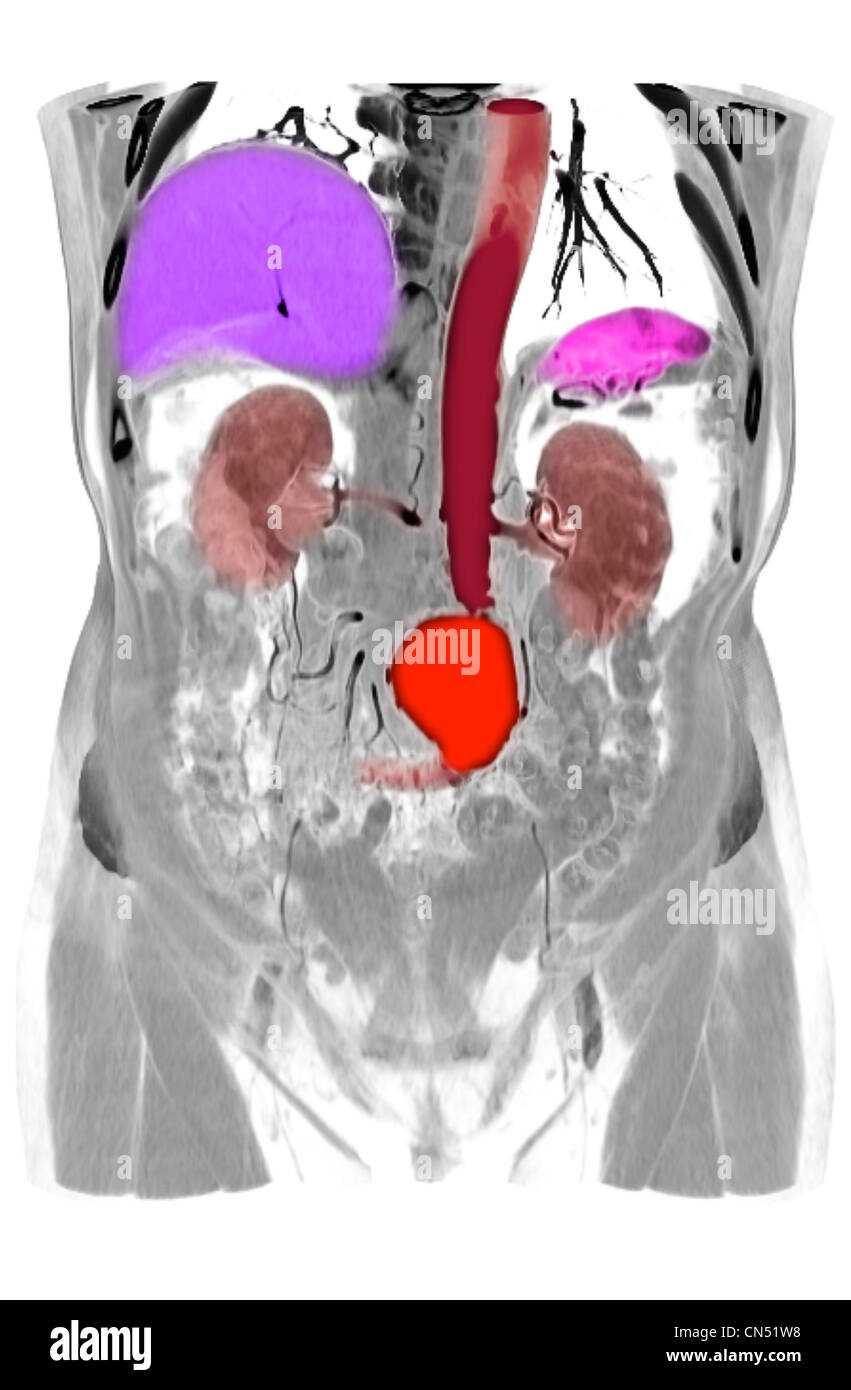 CT scan images showing an abdominal aortic aneurysm Stock Photo