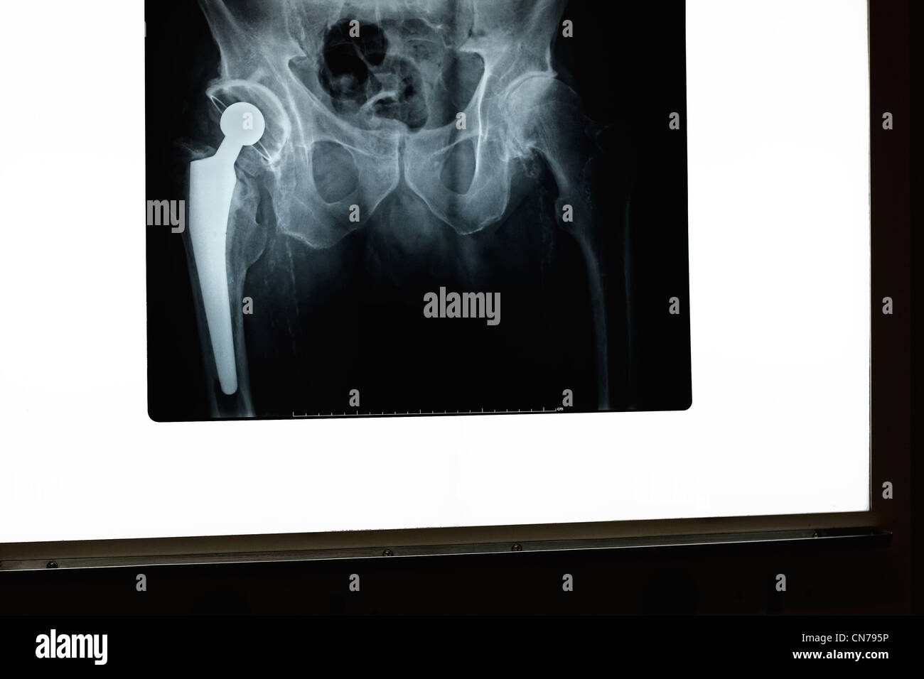 A x-ray of a hip and prosthesis on a x-ray screen Stock Photo