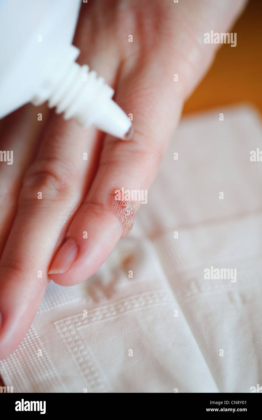 disinfect the scratch by rubbing in alcohol cuts on the hand Stock