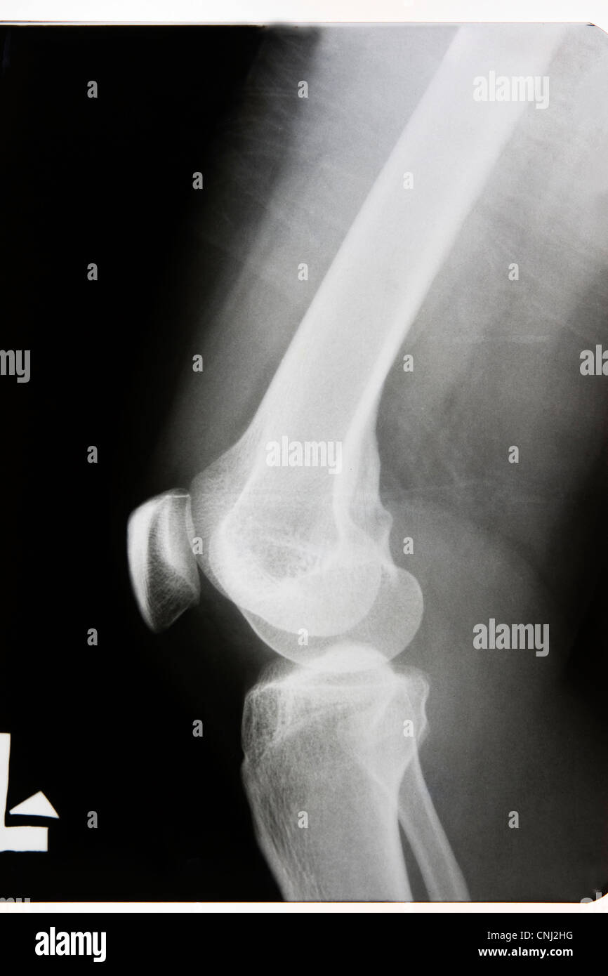 Leg x ray hi-res stock photography and images - Alamy