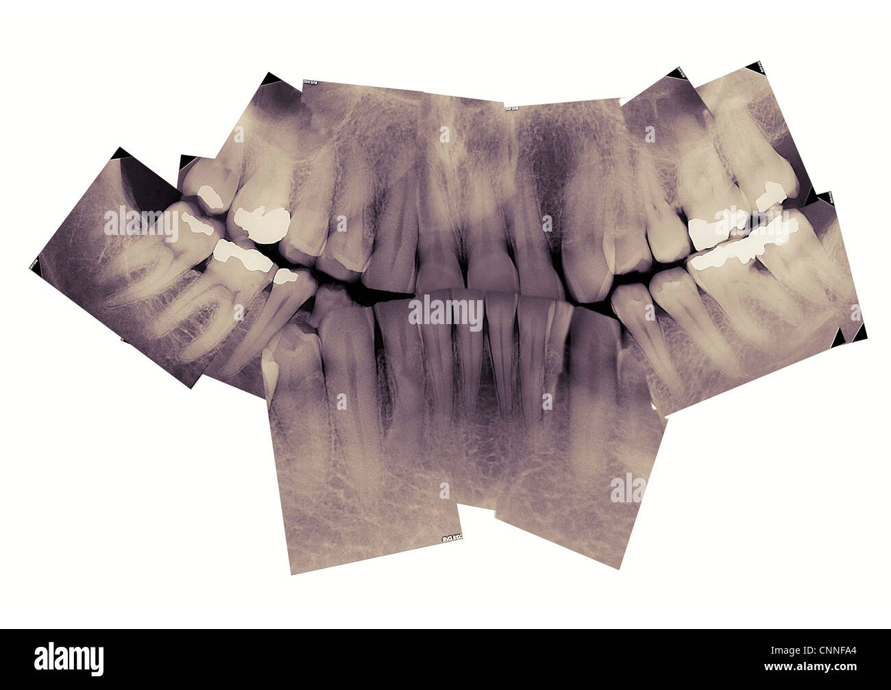 X-rays of Mature Teeth Stock Photo