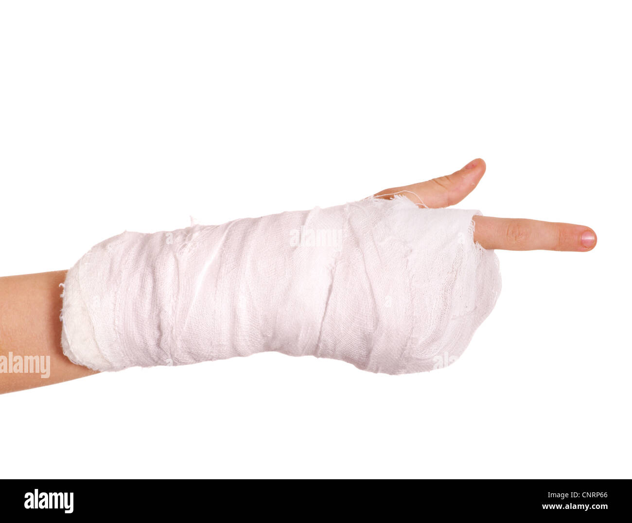 Broken arm in a cast Stock Photo Alamy