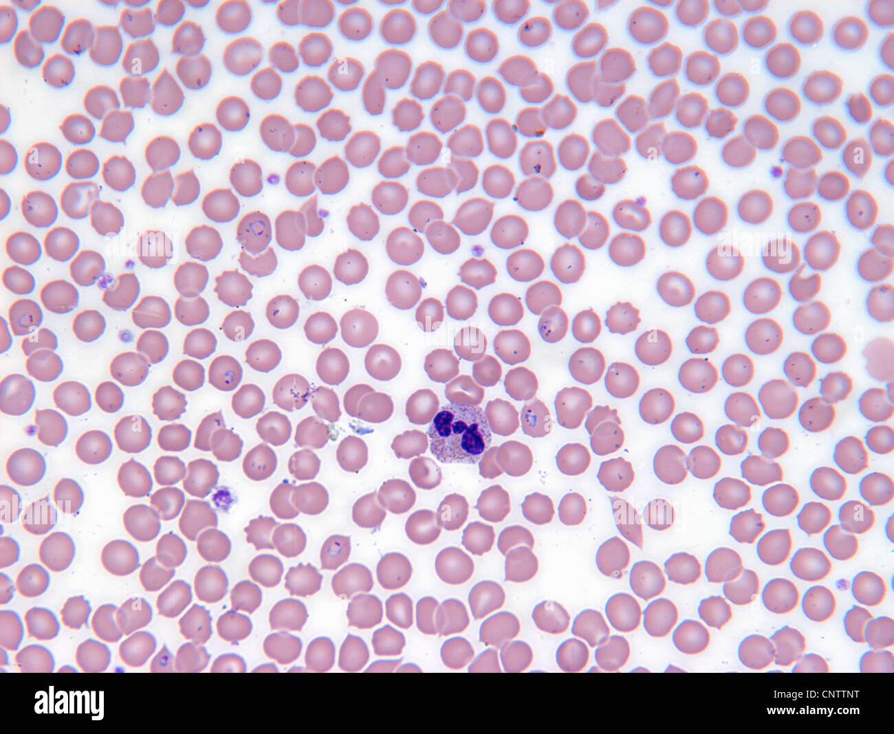 Malarial blood cells Stock Photo