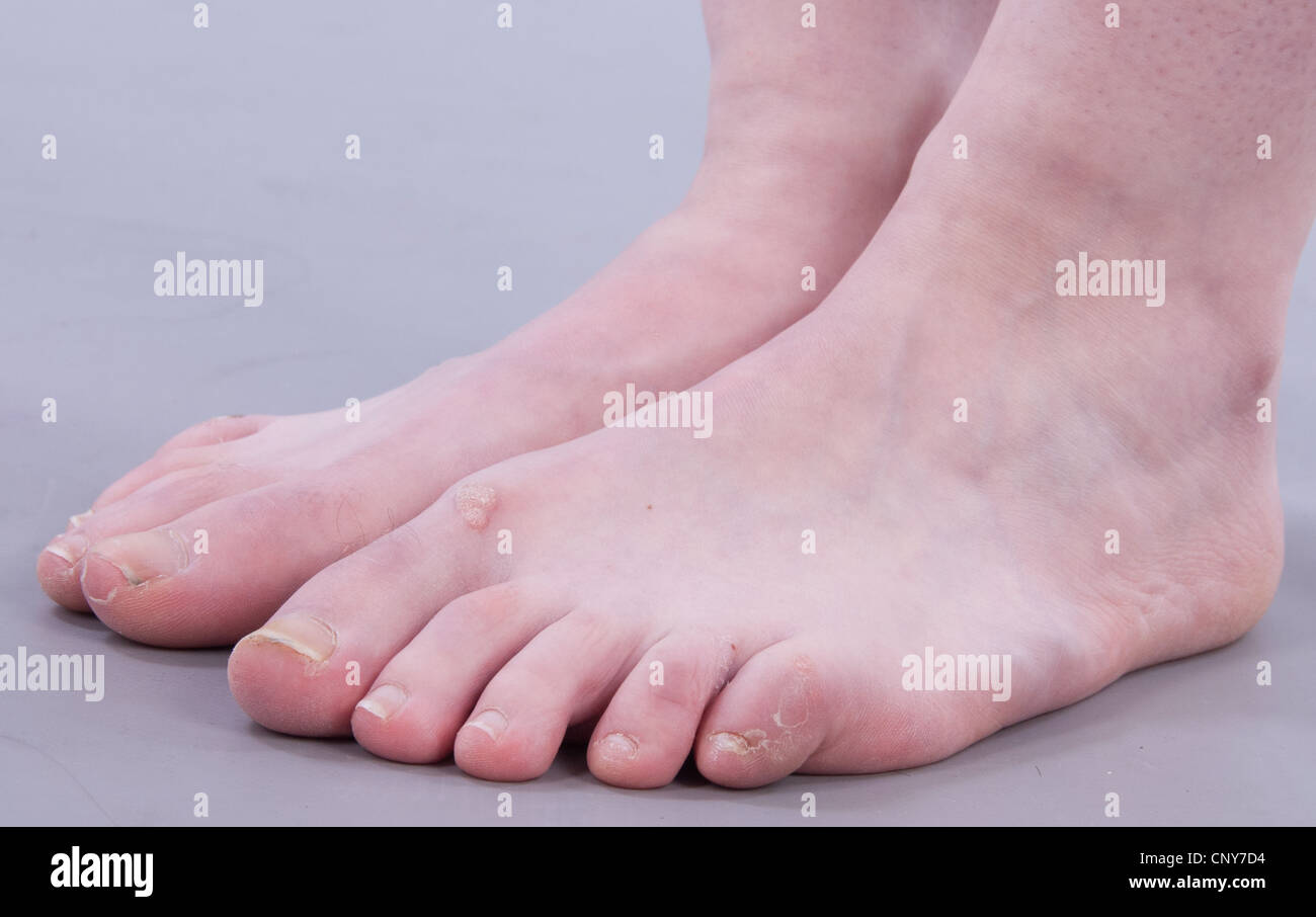 Ugly Caucasian female feet side view Stock Photo