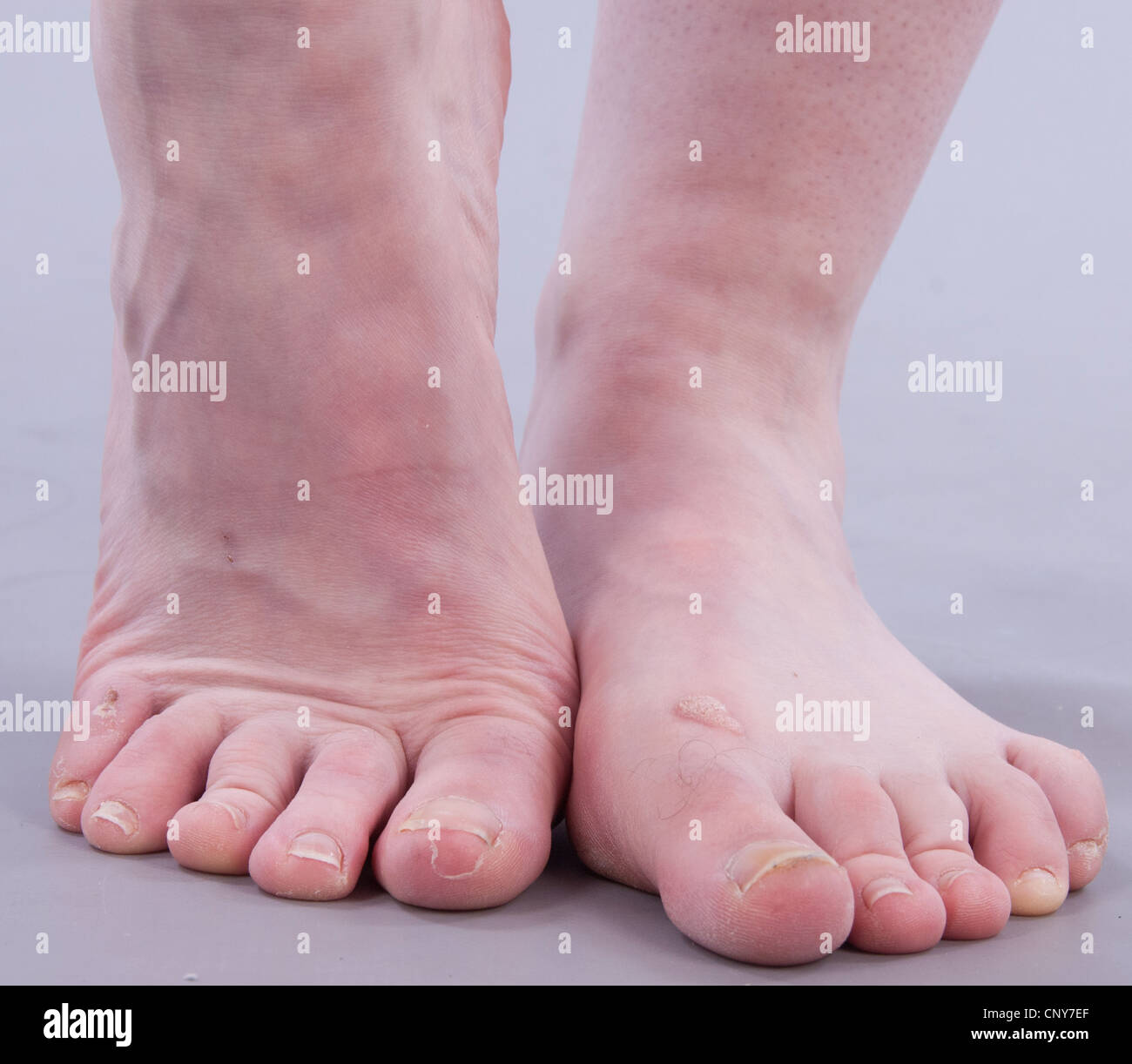 Caucasian female ugly feet Stock Photo