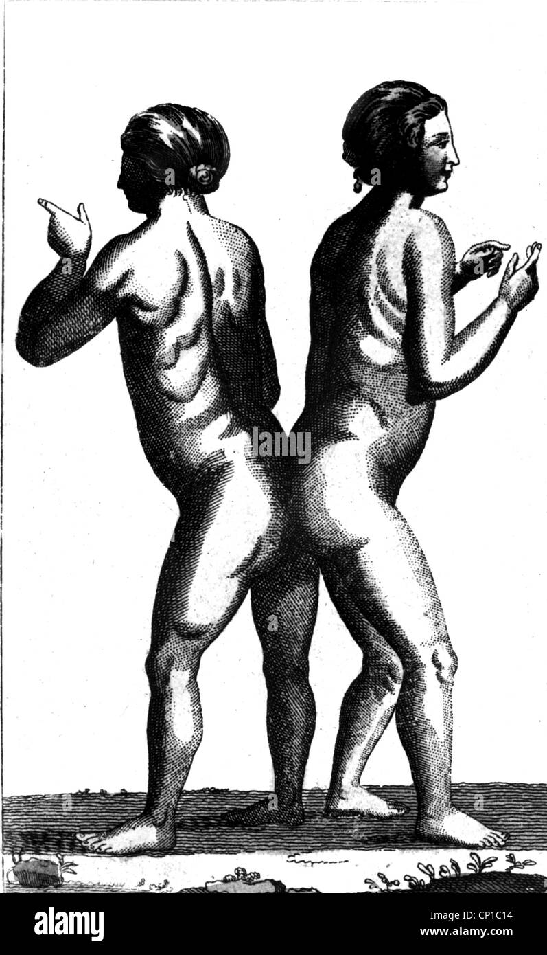 medicine, anomalies, Siamese twins, copper engraving, 18th century, historic, historical, misshapen, genetic defect, genetic defects, twin, anomaly, people, two women, woman, Additional-Rights-Clearences-Not Available Stock Photo