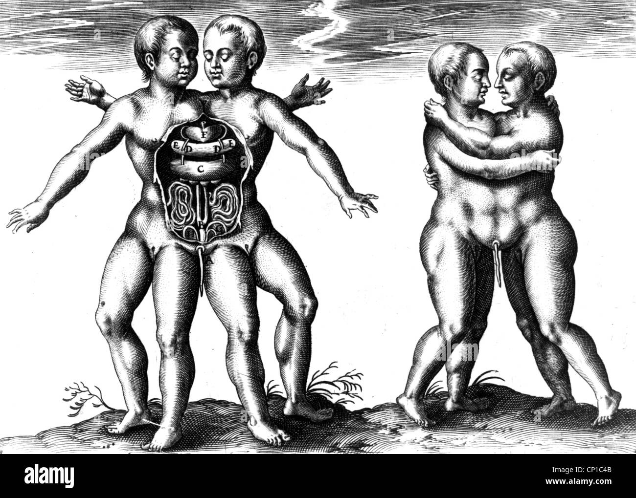 medicine, anomalies, Siamese twins, open corpus with bowels, copper engraving, 18th century, historic, historical, misshapen, genetic defect, genetic defects, twin, anomaly, people, umbilical cord, heart, intestine, intestines, Additional-Rights-Clearences-Not Available Stock Photo
