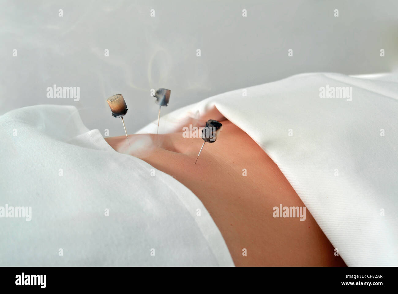 Patient during a Moxa treatment in traditional Chinese medicine. Stock Photo
