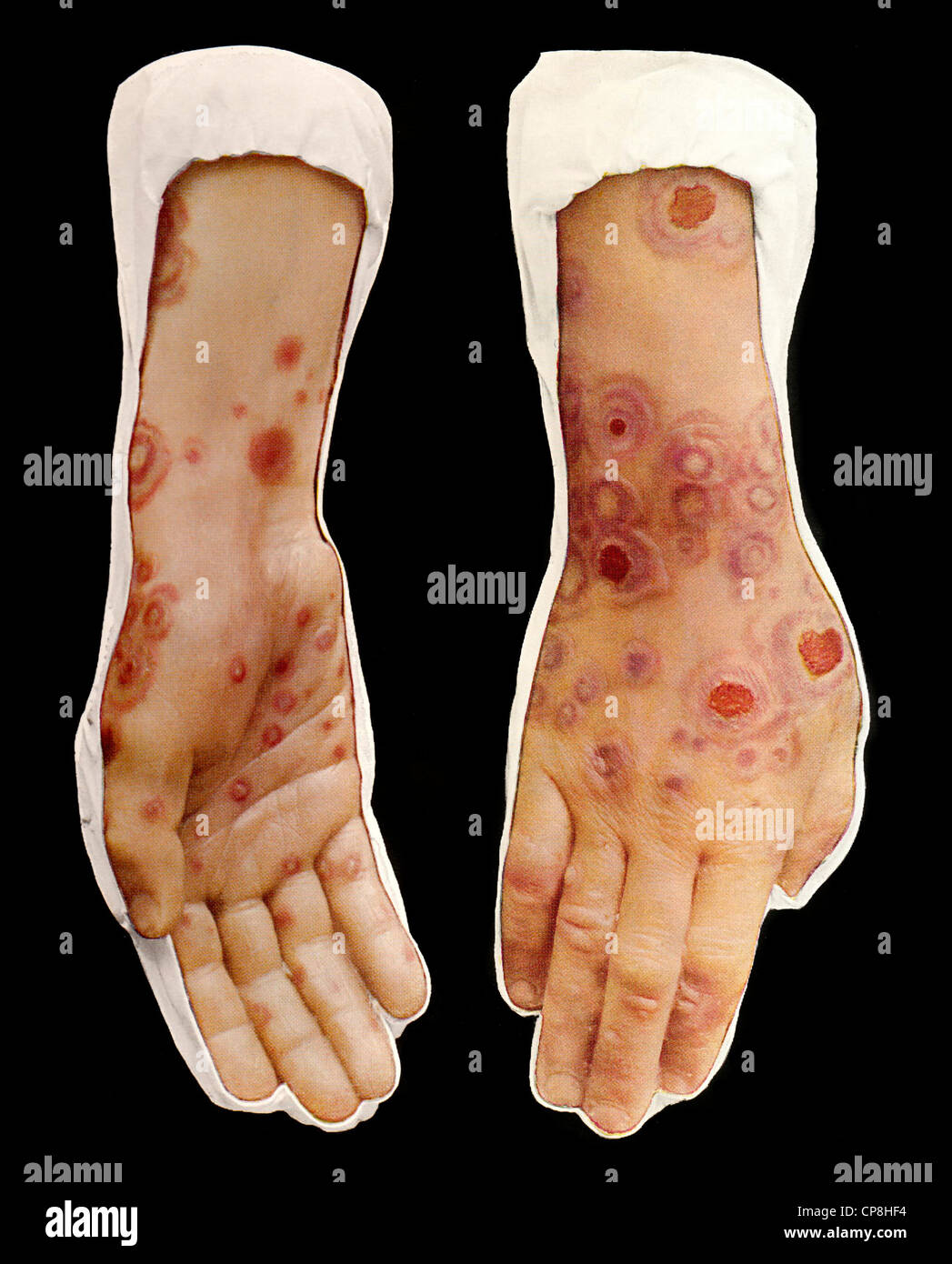 Handbemalte Abformungen erkrankter Körperteile, Moulage aus dem 19. Jahrhundert, Erythema exsudativum multiforme, eine akute ent Stock Photo