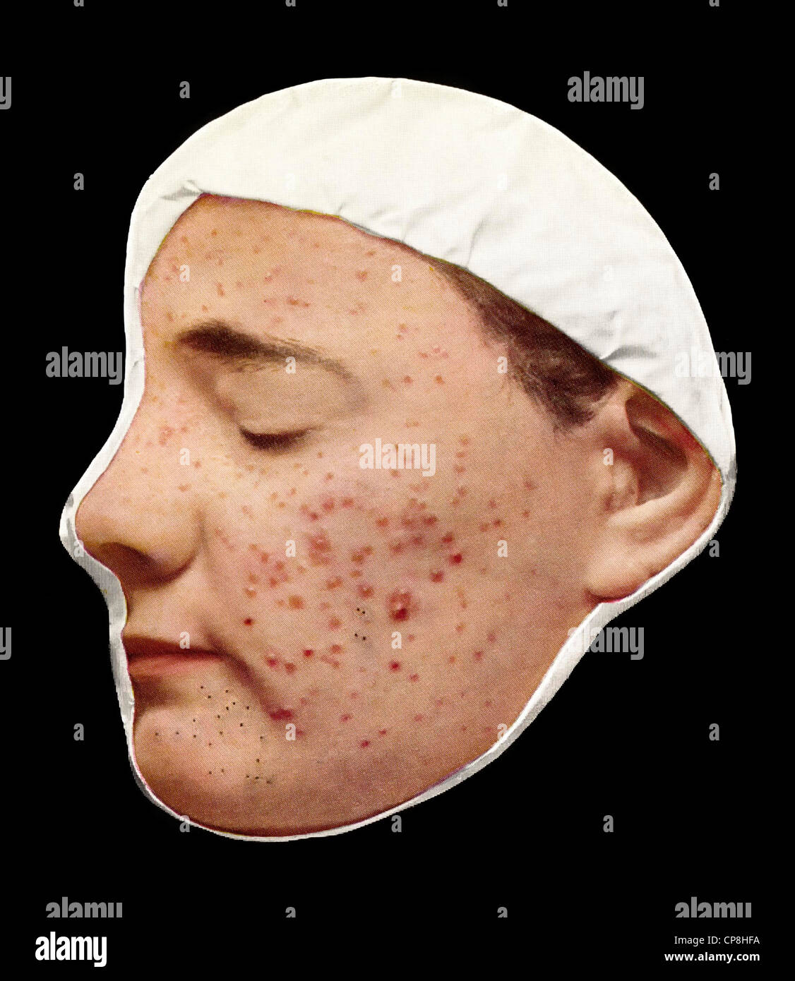 Handbemalte Abformungen erkrankter Körperteile, Moulage aus dem 19. Jahrhundert, Akne oder Acne vulgaris Stock Photo