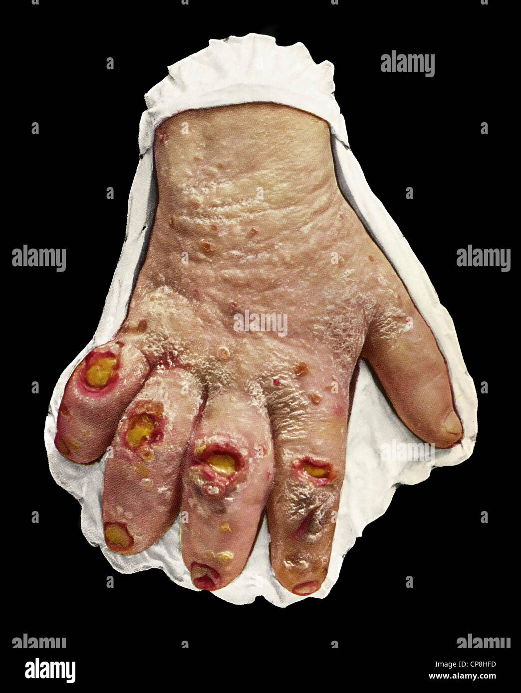 Handbemalte Abformungen erkrankter Körperteile, Moulage aus dem 19. Jahrhundert, tuberkuloide Lepra, chronische Infektionskrankh Stock Photo