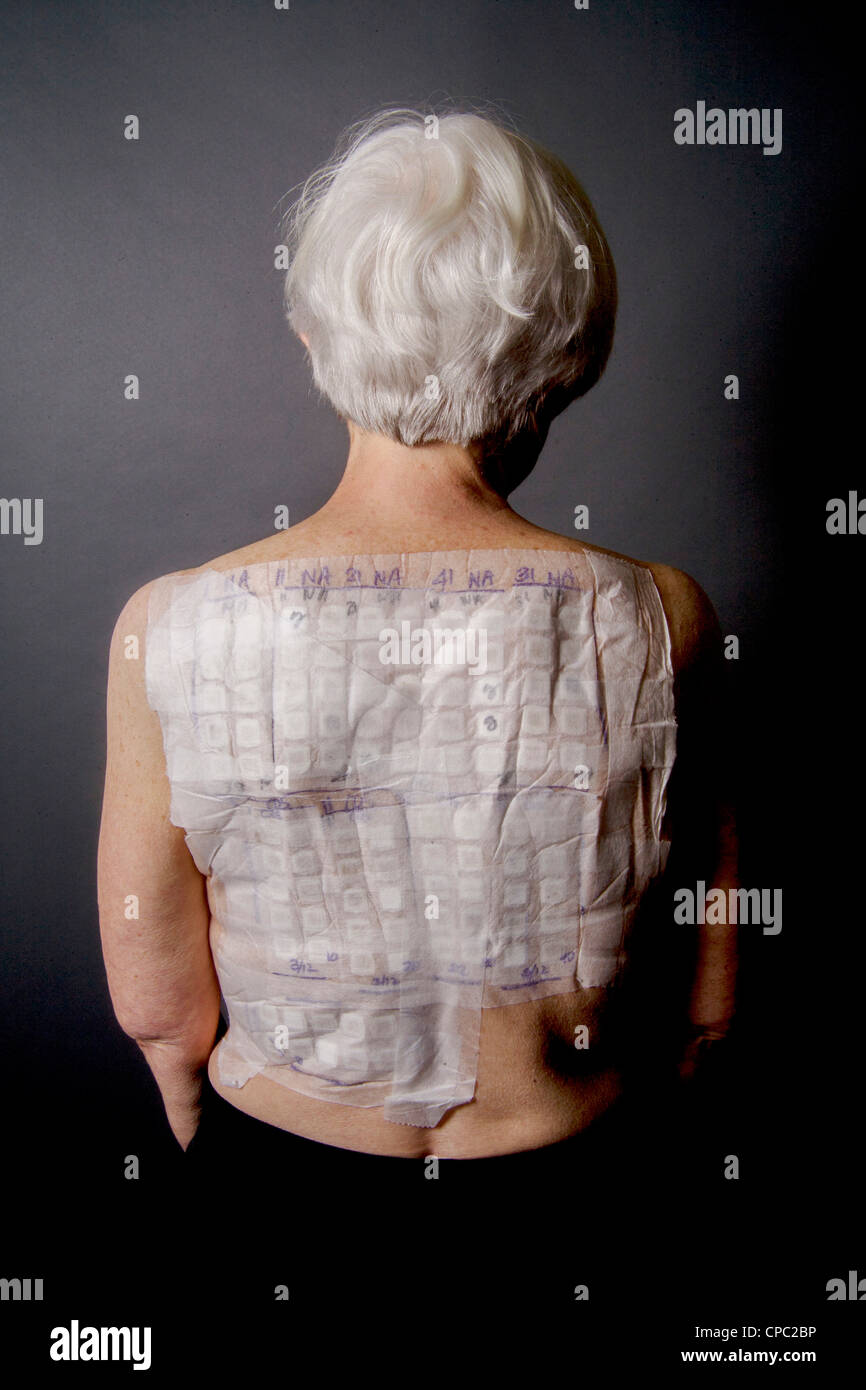 A woman patient's back is covered with the patches of an Chemotechnique Allergan Series to determine specific allergic reactions Stock Photo