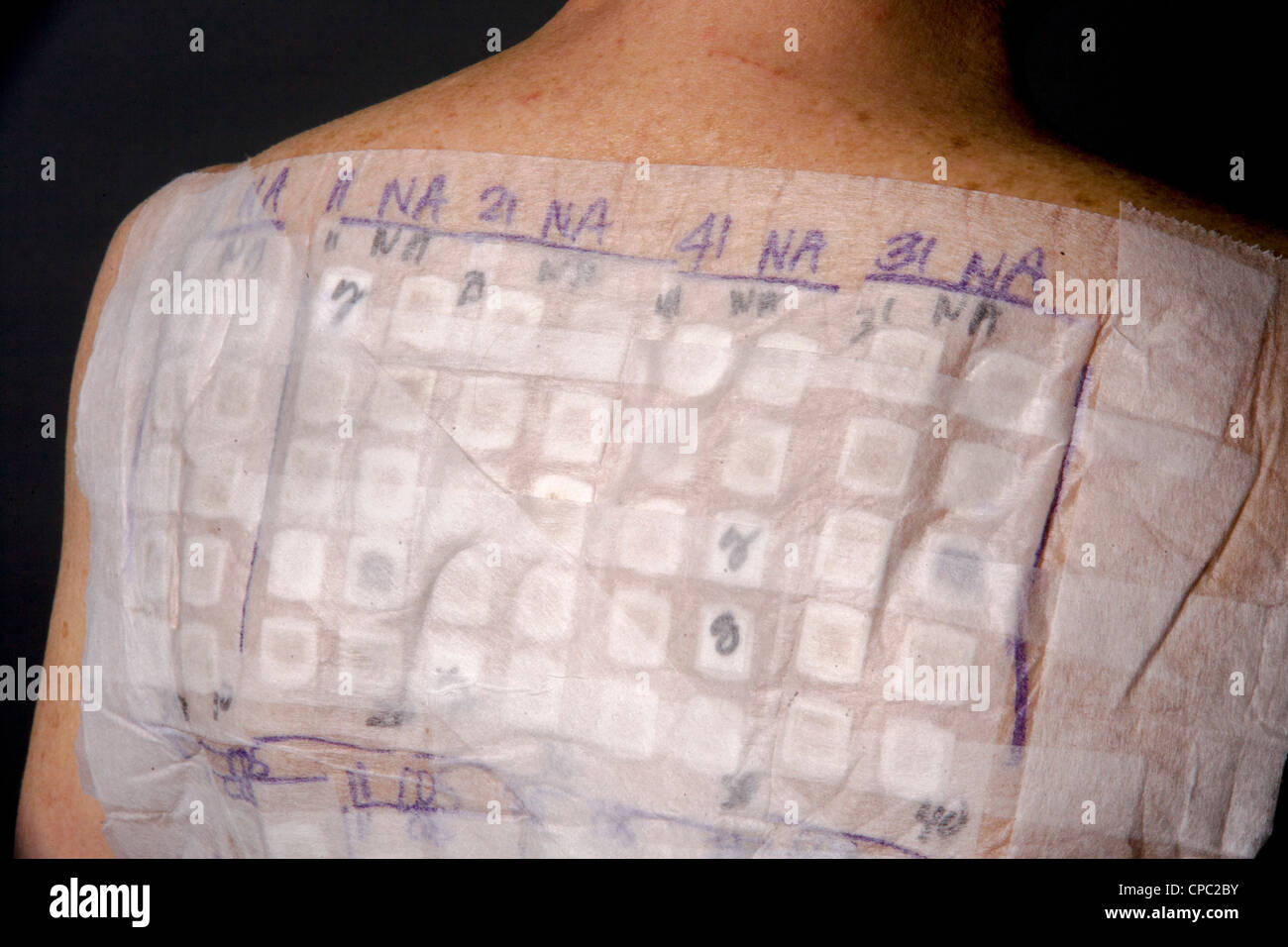 A woman patient's back is covered with the patches of an Chemotechnique Allergan Series to determine specific allergic reactions Stock Photo