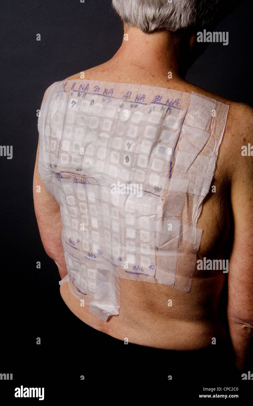 A woman patient's back is covered with the patches of an Chemotechnique  Allergan Series to determine specific allergic reactions Stock Photo - Alamy