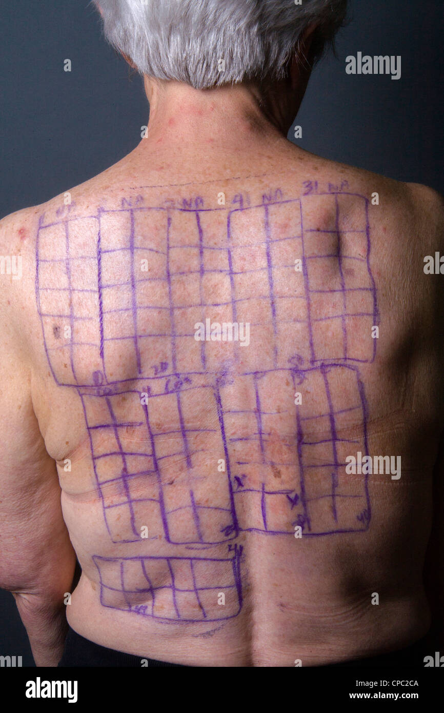 A woman patient's back is drawn with squares indicating locations for the patches of a Chemotechnique Allergan Series. Stock Photo