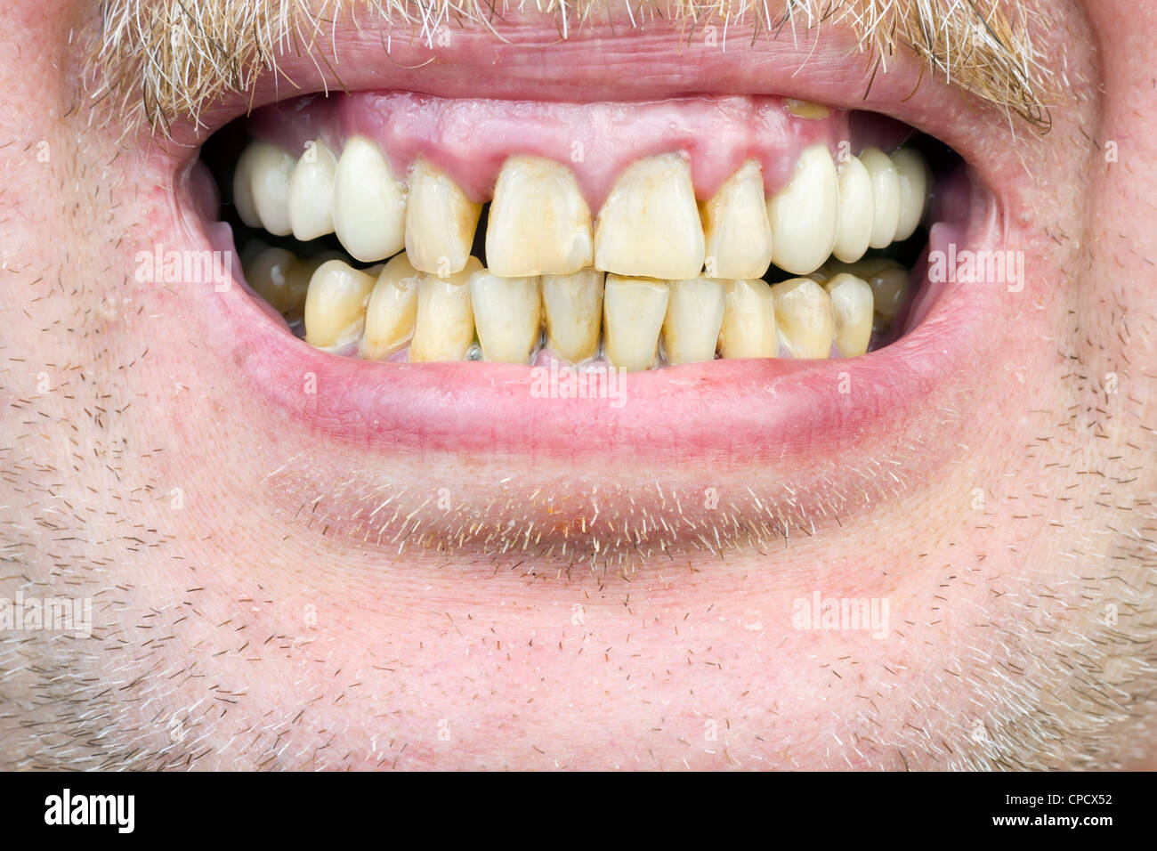 Yellow teeth, diseased gums, yellow men's skin mustache macro. The harm