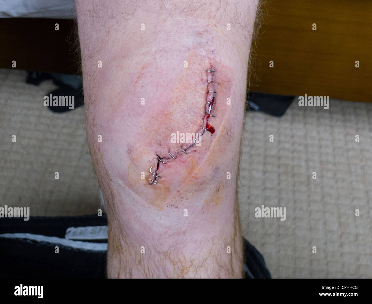 Knee following surgery Stock Photo