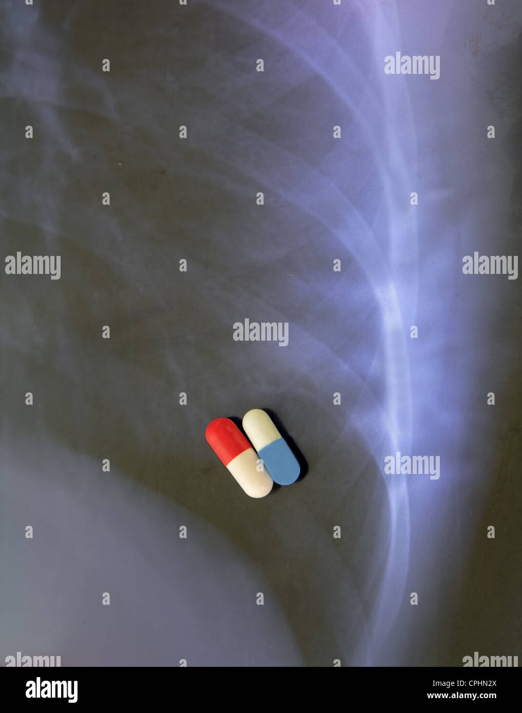 Image of two types of antibiotic capsules over a pulmonary radiography . Stock Photo