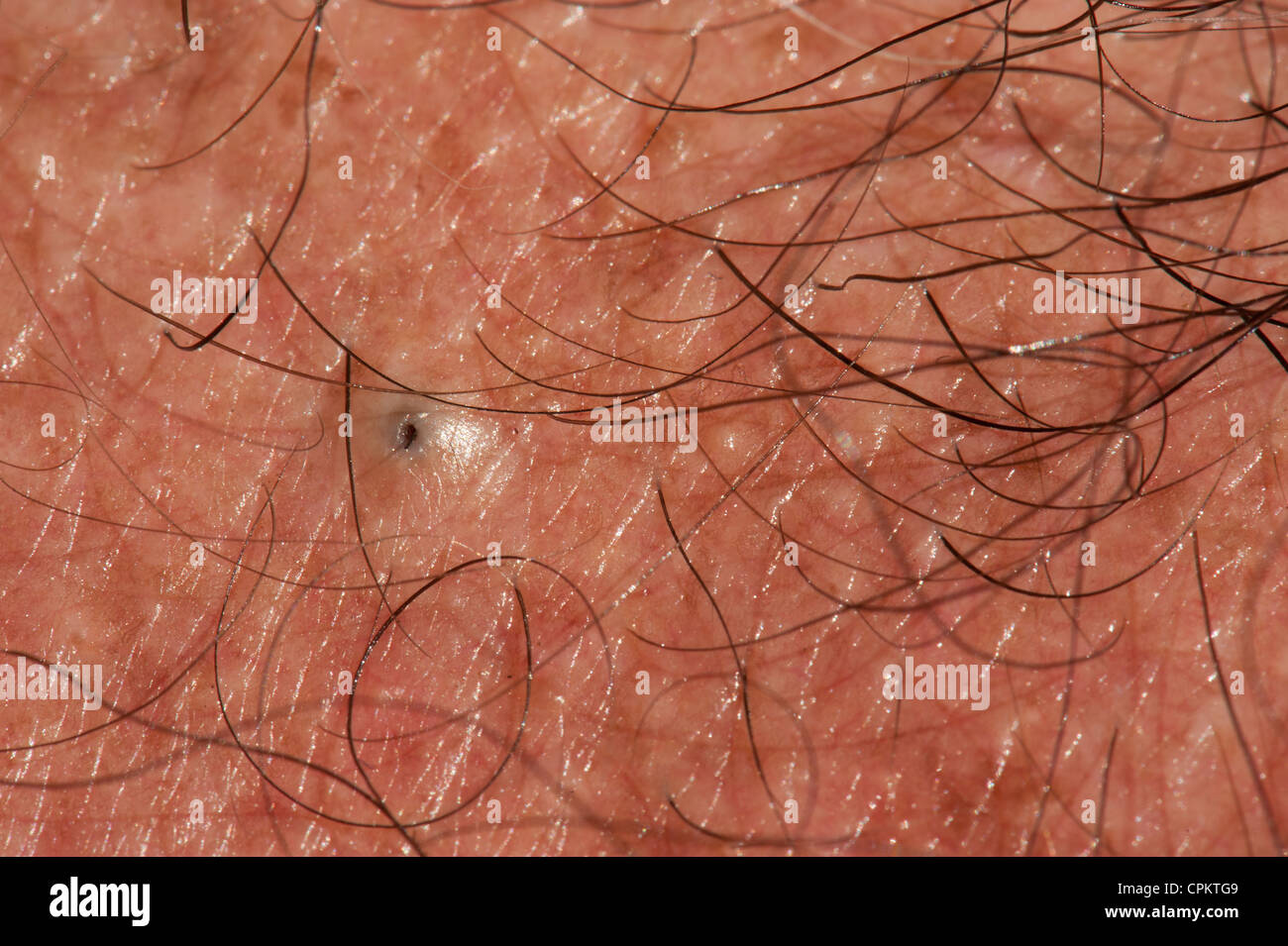 A forming blackhead on chest Stock Photo