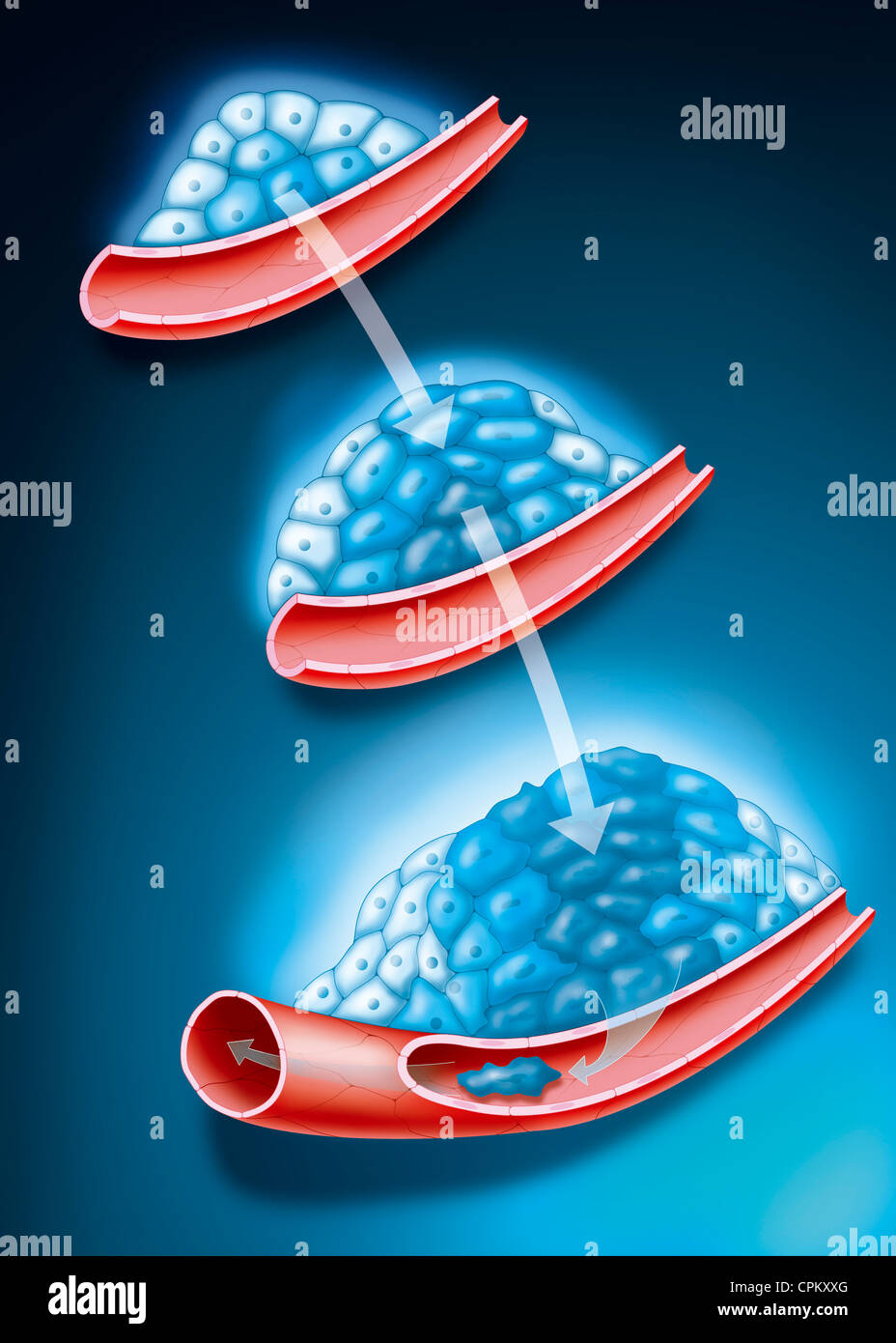 Tumor neoplasms hires stock photography and images Alamy