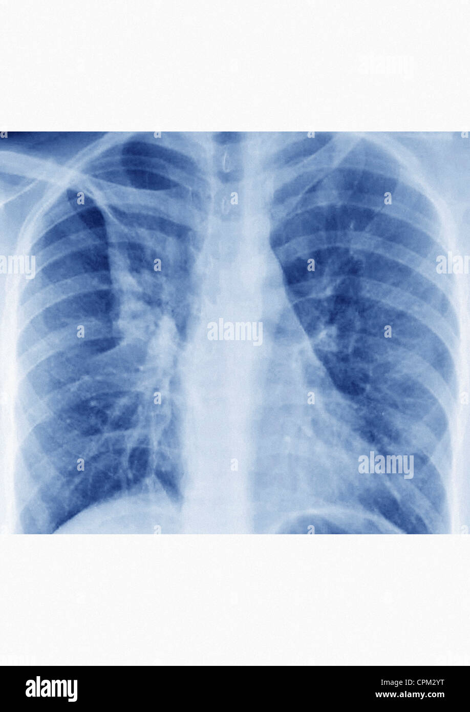 BRONCHITIS, XRAY Stock Photo Alamy