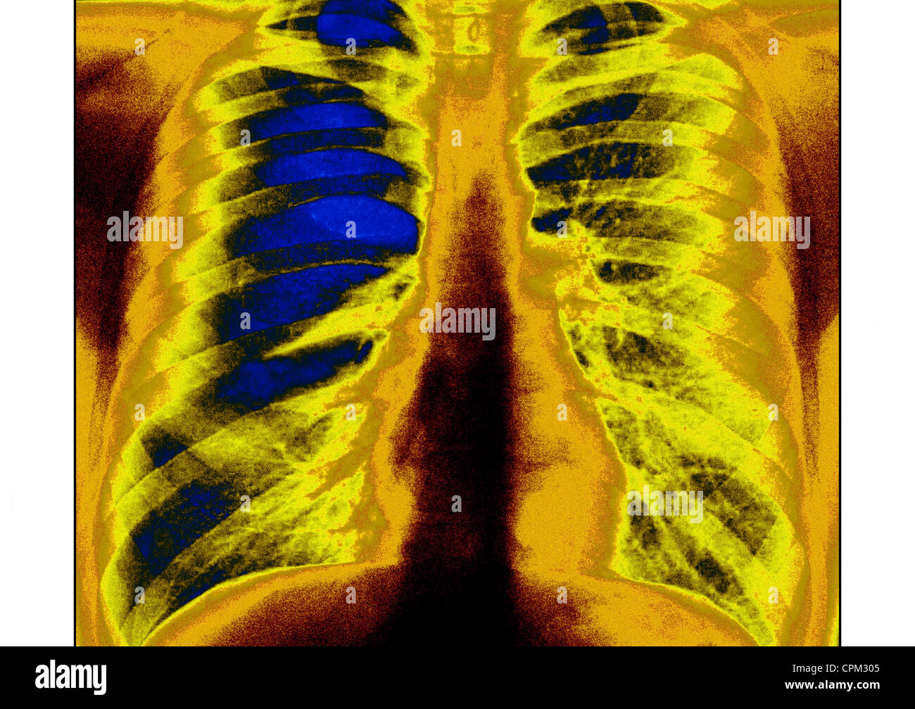 ASTHMA, XRAY Stock Photo Alamy