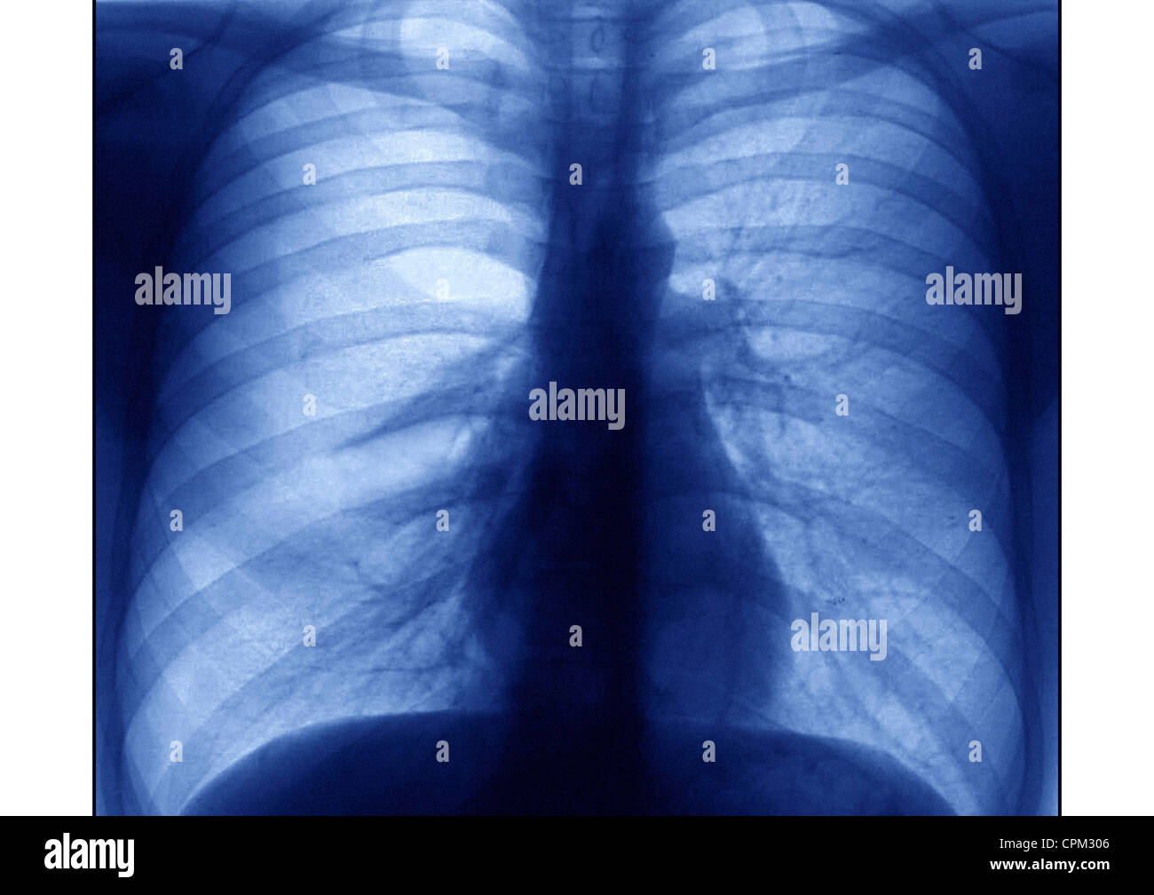 ASTHMA, XRAY Stock Photo Alamy