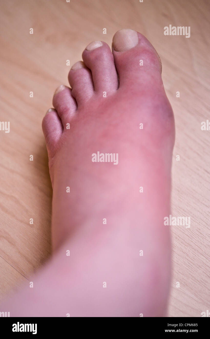 Gout Foot High Resolution Stock Photography and Images - Alamy