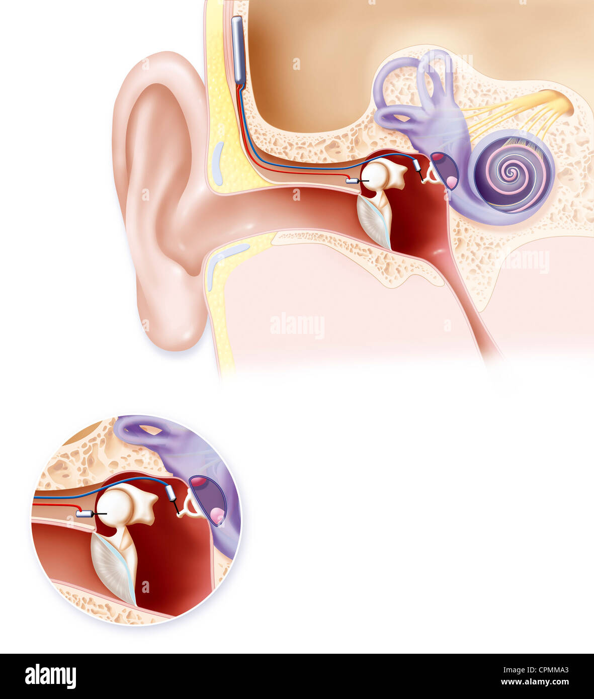 COCHLEAL IMPLANT Stock Photo