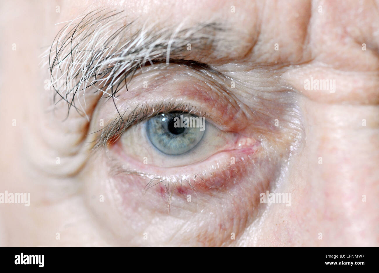 medicine, diseases, eye of a 89-year old man, affected by a advanced cataract, Germany, Additional-Rights-Clearance-Info-Not-Available Stock Photo